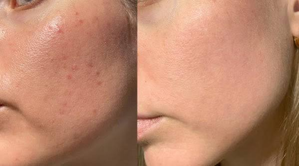 Sensitive Skin
